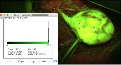 Intraoperative Sodium-Fluorescence Imaging in Peripheral Nerve Sheath Tumors (PNST)—A New Additional Promising Diagnostic Tool